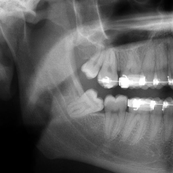 Wisdom Teeth – Hornsby Oral and Maxillofacial Surgery